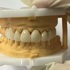 Layered  Zirconia Bridge/Crowns