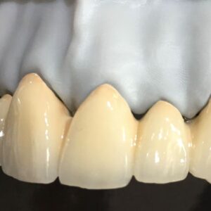 Porcelain-Fused-to-Metal(PFM)