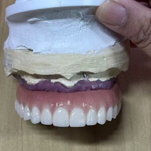 Implant Hybrid Bridge