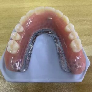 Overdenture